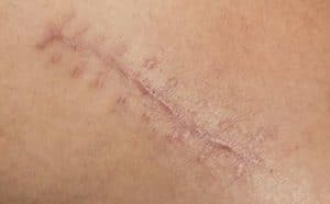 Pourquoi rêver de cicatrice ?