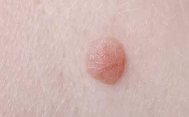 Rêver de grain de beauté : quelles interprétations, analyses et significations ?